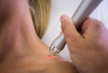 Dermatologist removing mole from womans shoulder with medical laser